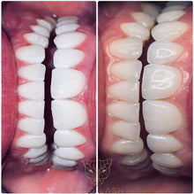 Lade das Bild in den Galerie-Viewer, Professional Zahnbleaching