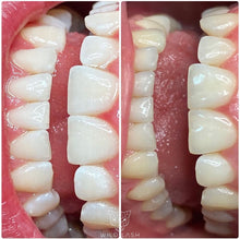 Lade das Bild in den Galerie-Viewer, Professional Zahnbleaching