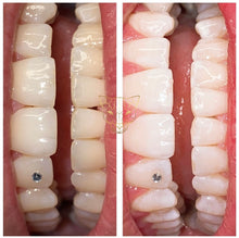 Lade das Bild in den Galerie-Viewer, Professional Zahnbleaching